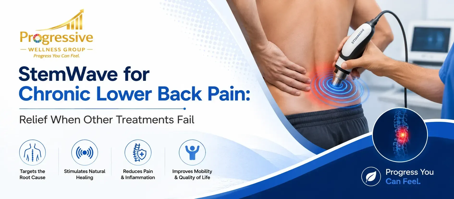 StemWave for Chronic Lower Back Pain: Relief When Other Treatments Fail